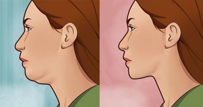 你的双下巴可能真不是胖出来的!