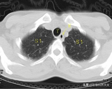 肺段支气管解剖